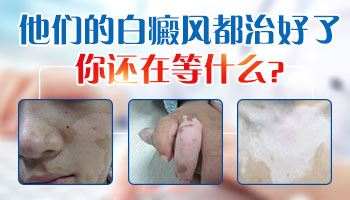 心理干预-儿童白癜风不仅要治疗，更要关注心理健康